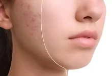 chemical peels for acne