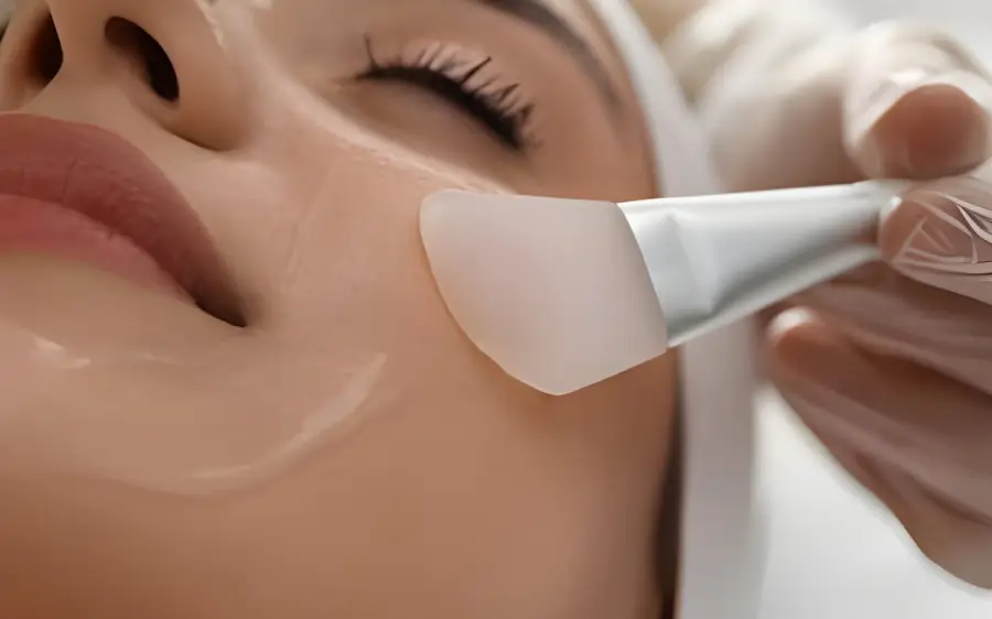 chemical peel for acne