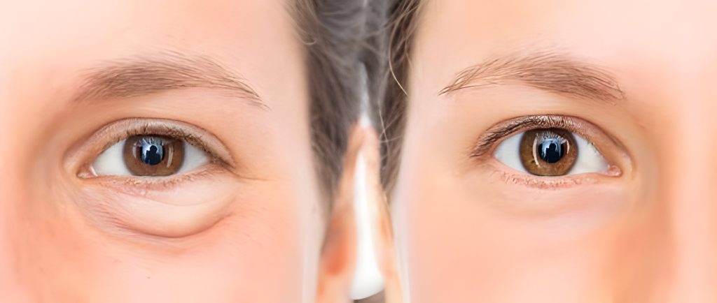 laser treatment for puffy eyes