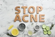 natural remedies for acne