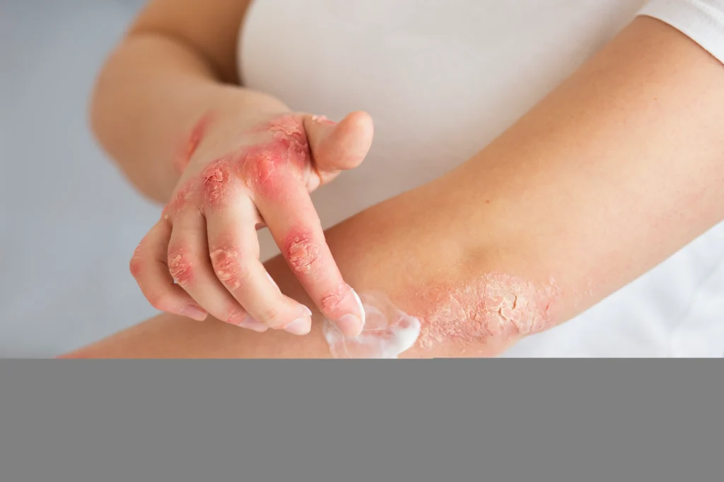 Psoriatic Arthritis