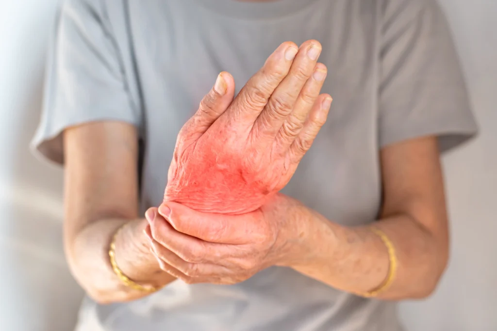 Psoriatic Arthritis