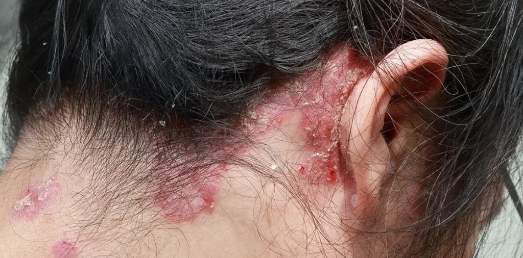 Psoriasis