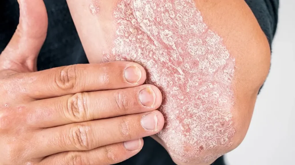 psoriasis