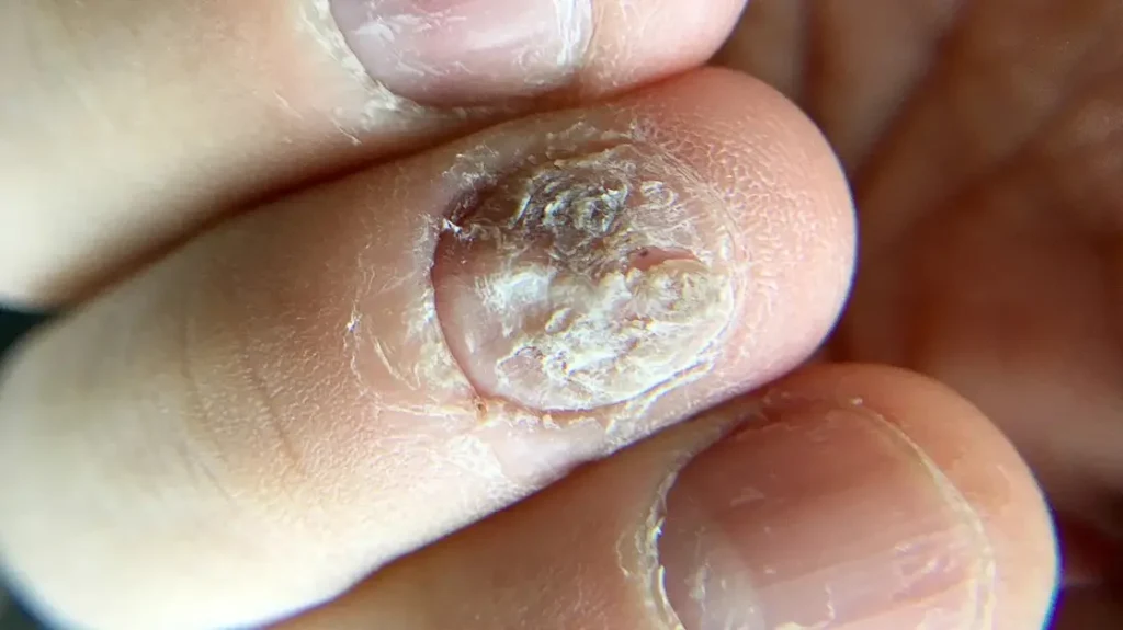 psoriasis