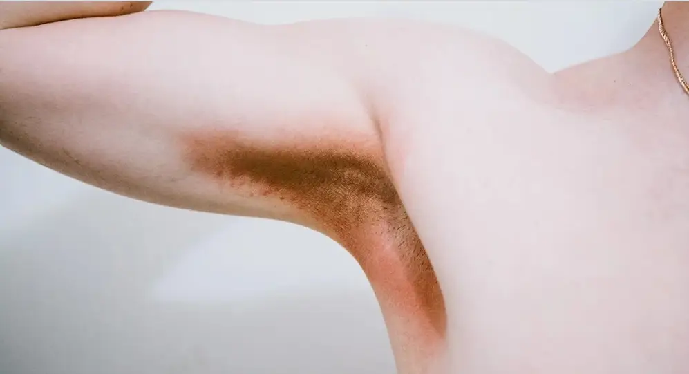 psoriasis